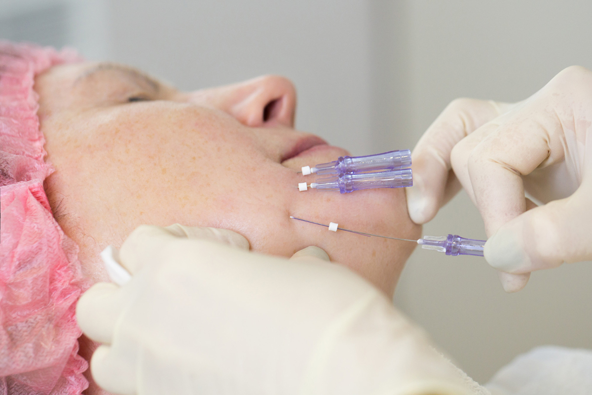 What Areas of the Face Can a PDO Thread Lift Treat?