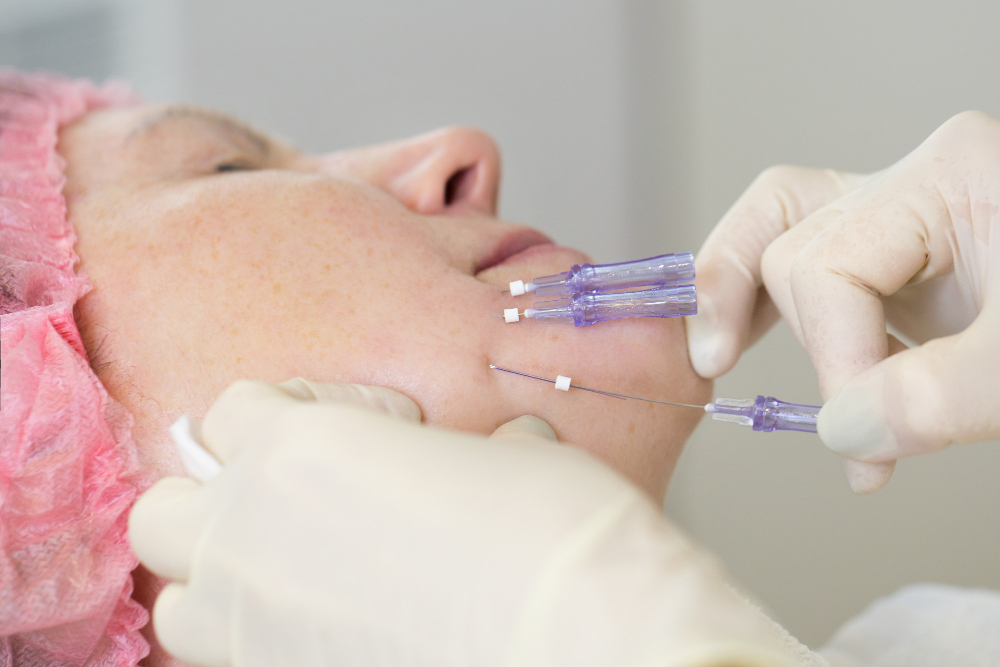 How Nonsurgical Face-Lifts Work With PDO Threads