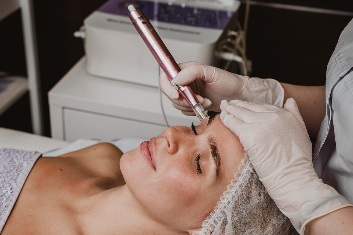 The Ultimate Guide to Microneedling Treatment Process