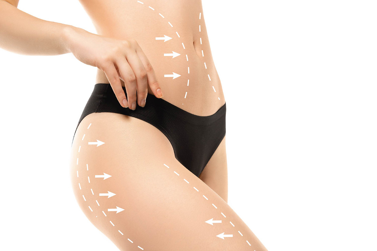 Liquid Lipo: Why it's Minimally Invasive