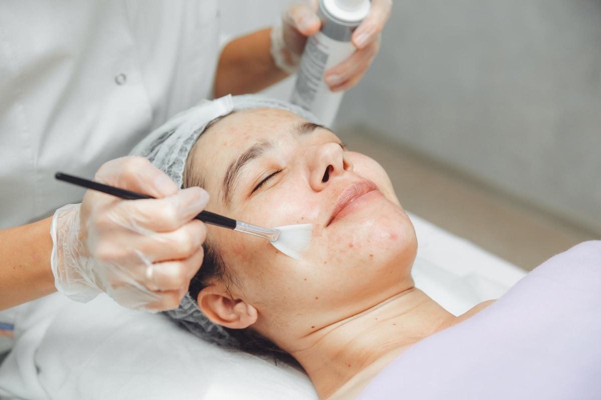 What to Expect Day by Day after Your Chemical Peel Process