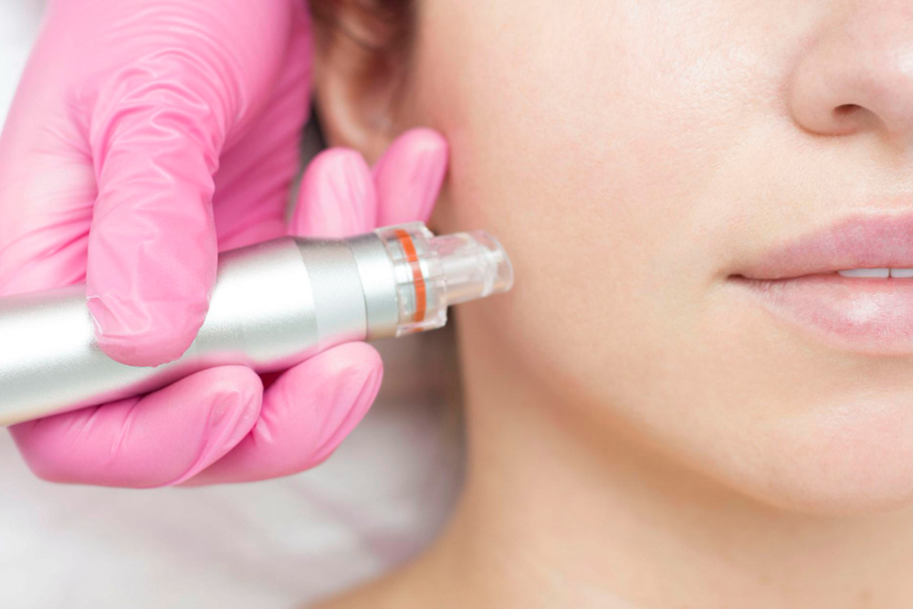Here's Why Microneedling has Become so Popular