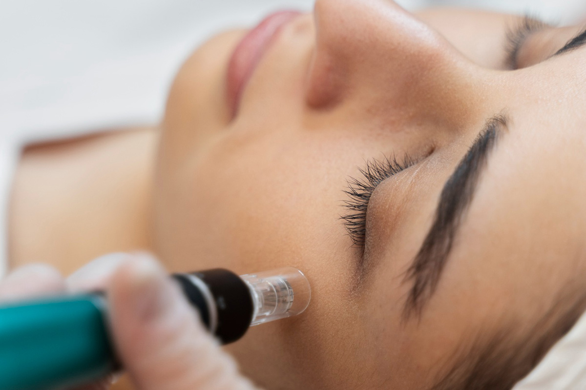 The Benefits of Microneedling for Your Skin