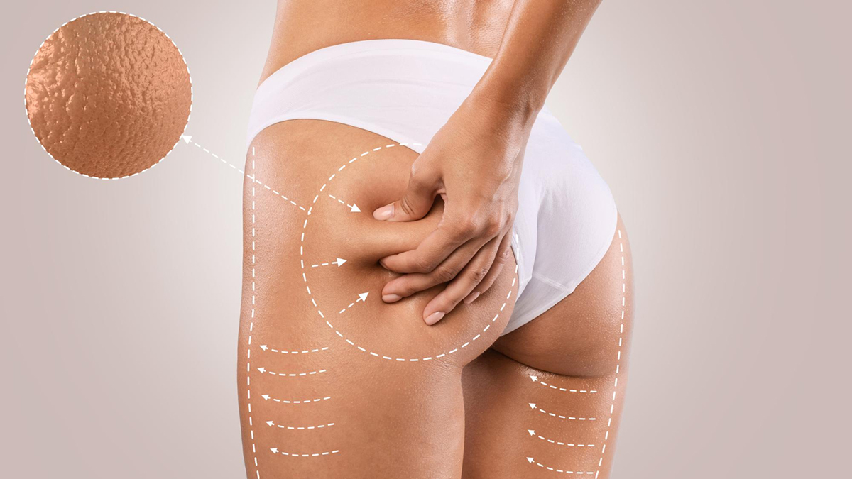 Benefits of a Radiesse Butt Lift