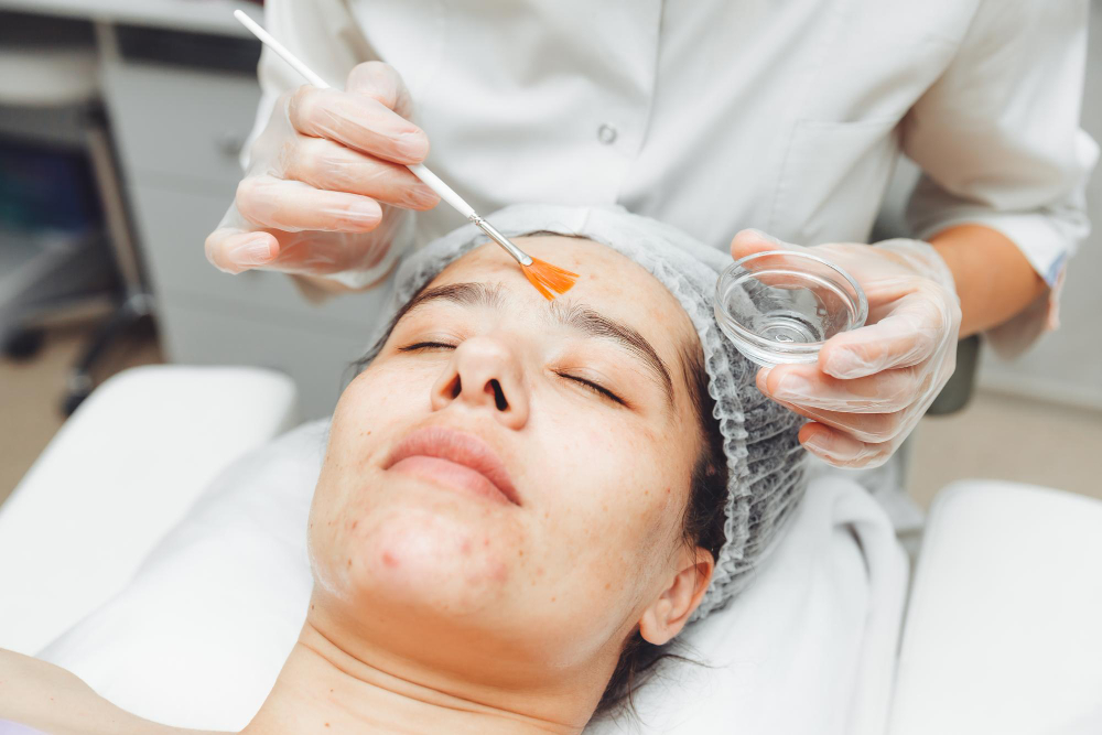 The Benefits Of Chemical Peels To Treat Acne Scarring