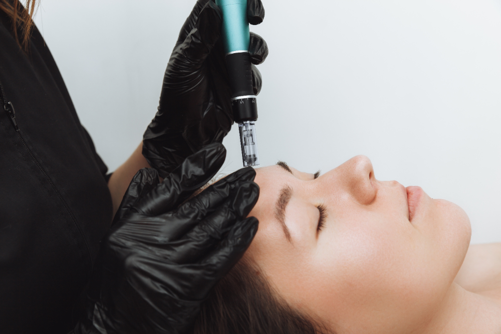 The Ultimate Guide to Microneedling: Techniques, Benefits, and What to Expect