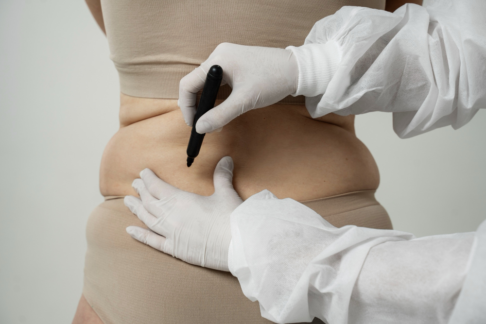 What Is Liquid Liposuction? Everything You Need to Know