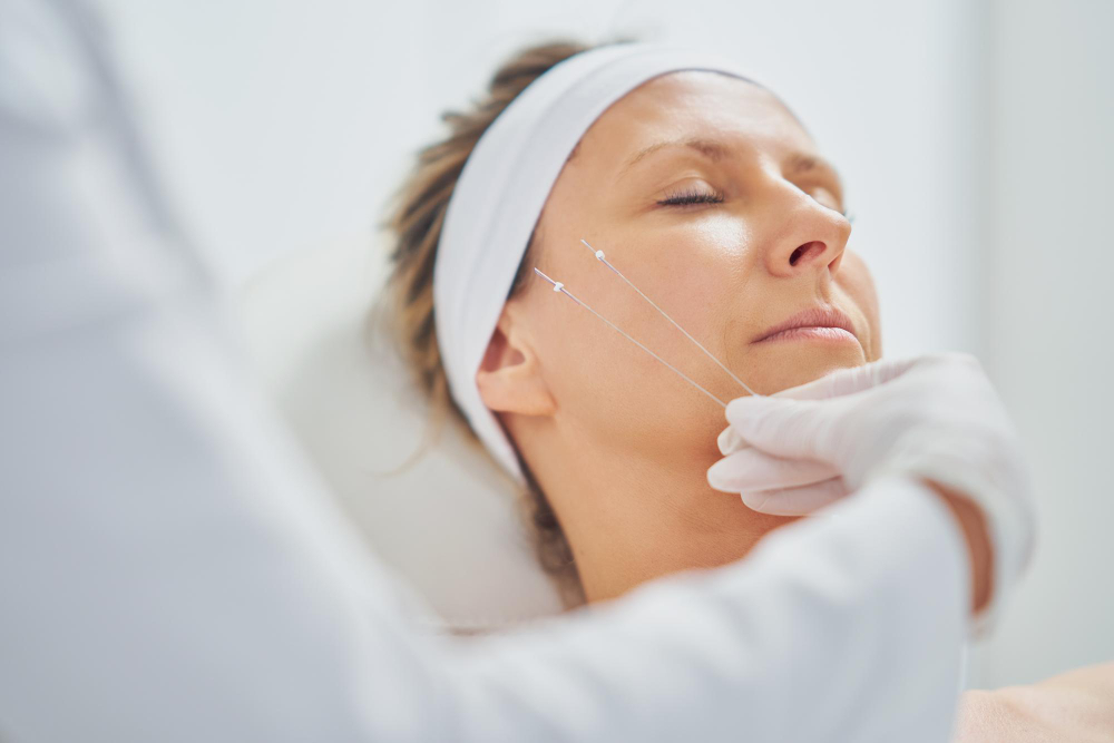 How Long Does a PDO Thread Lift Last?