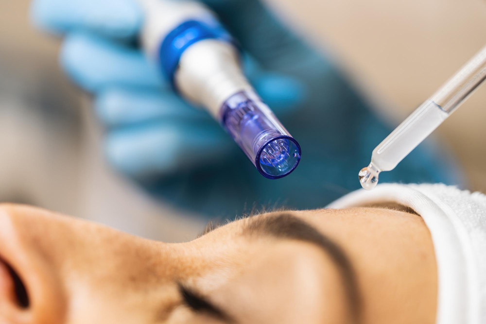 How Microneedling Supercharges Your Skincare Routine