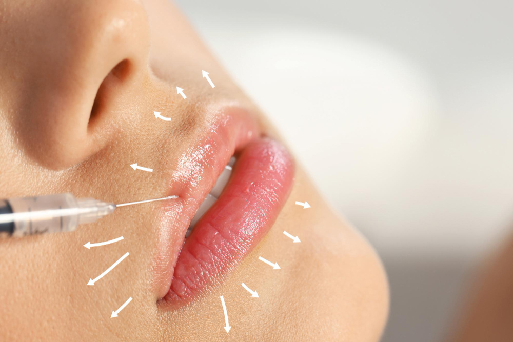 How Fillers Create Subtle Lip Enhancement