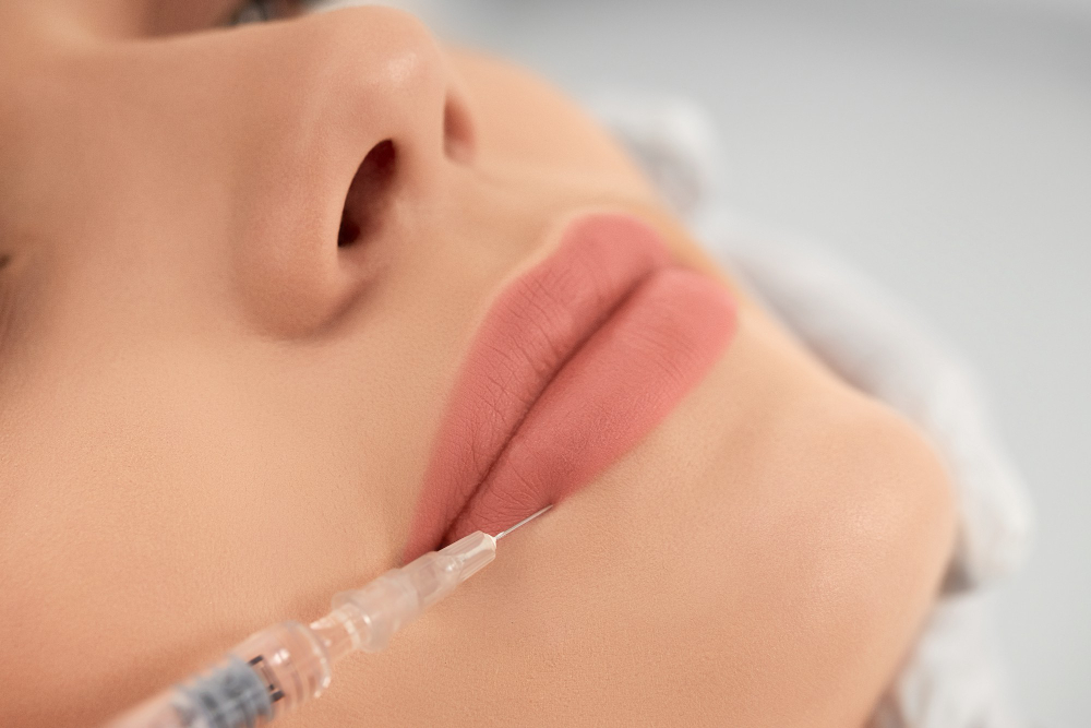 Why Fillers are the Best Treatment for Lip Lines