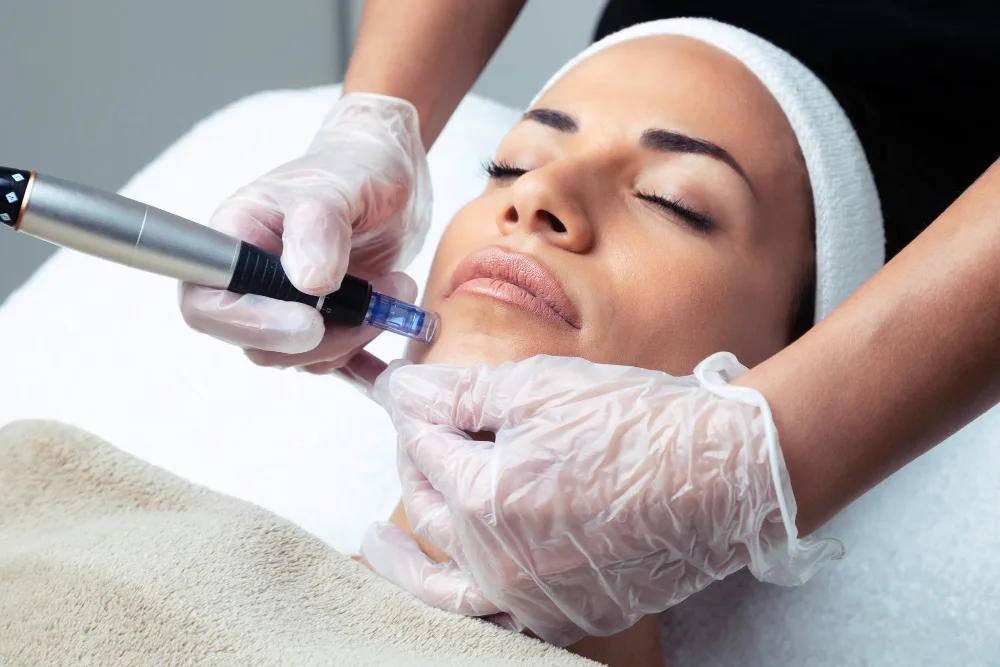 How Long Do the Results from Microneedling Last?
