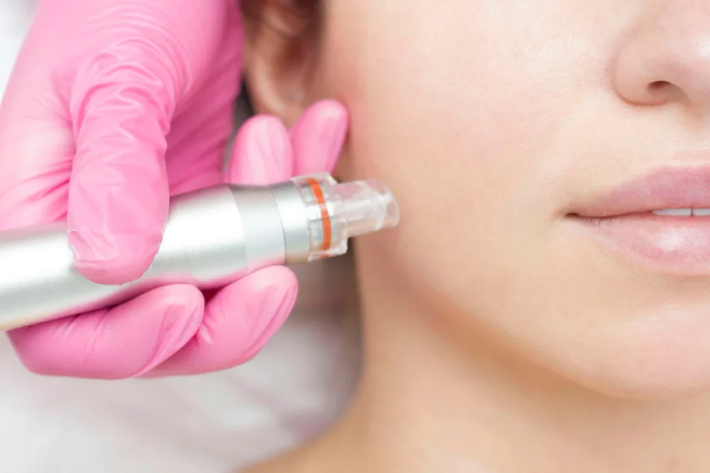 Here's Why Microneedling has Become so Popular