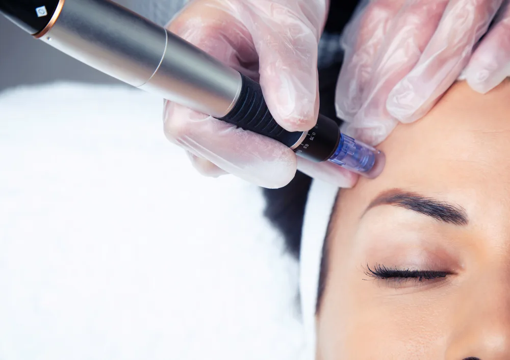 Does Microneedling Shrink Pore Size?