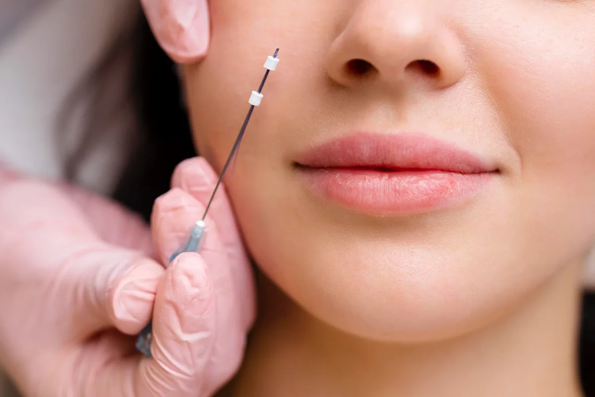 All about PDO Thread lift procedure