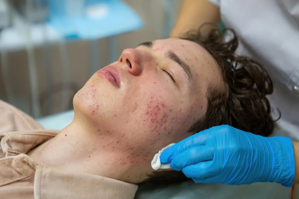 How Chemical Peels Help Treat Active Acne